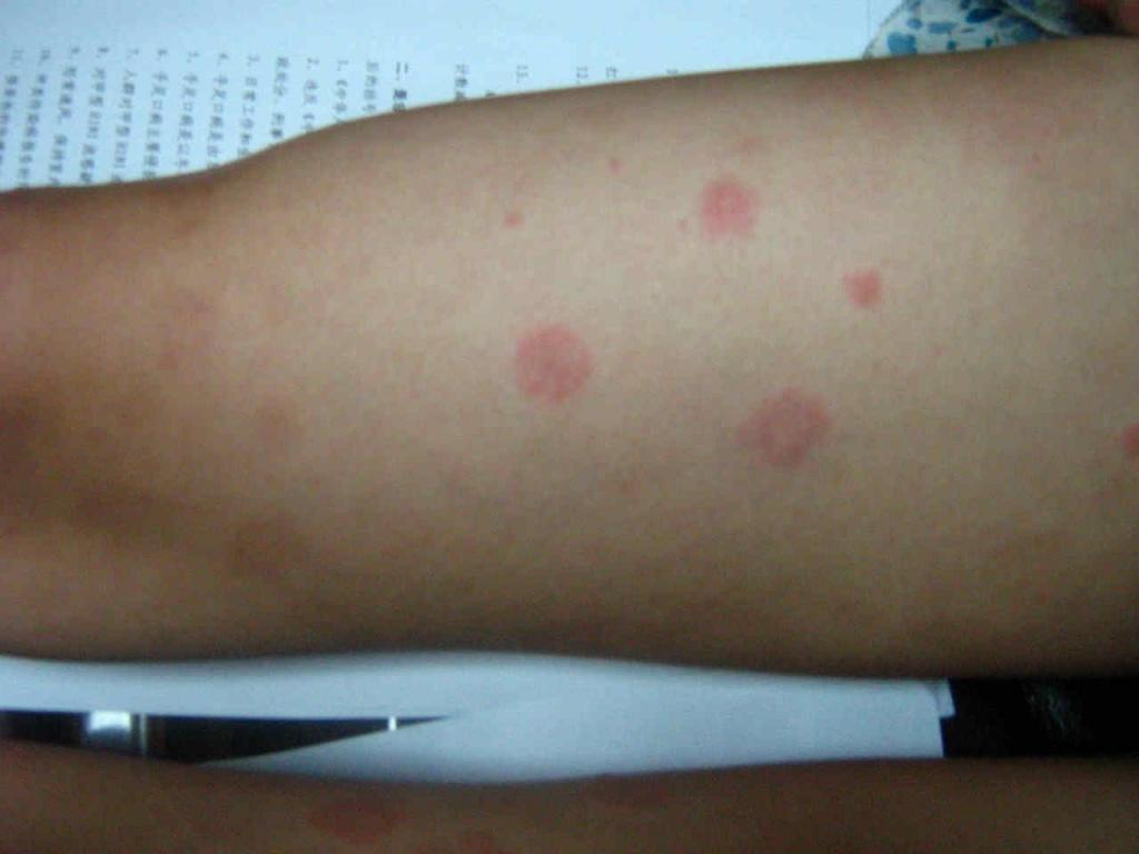 血管炎性荨麻疹图片图片