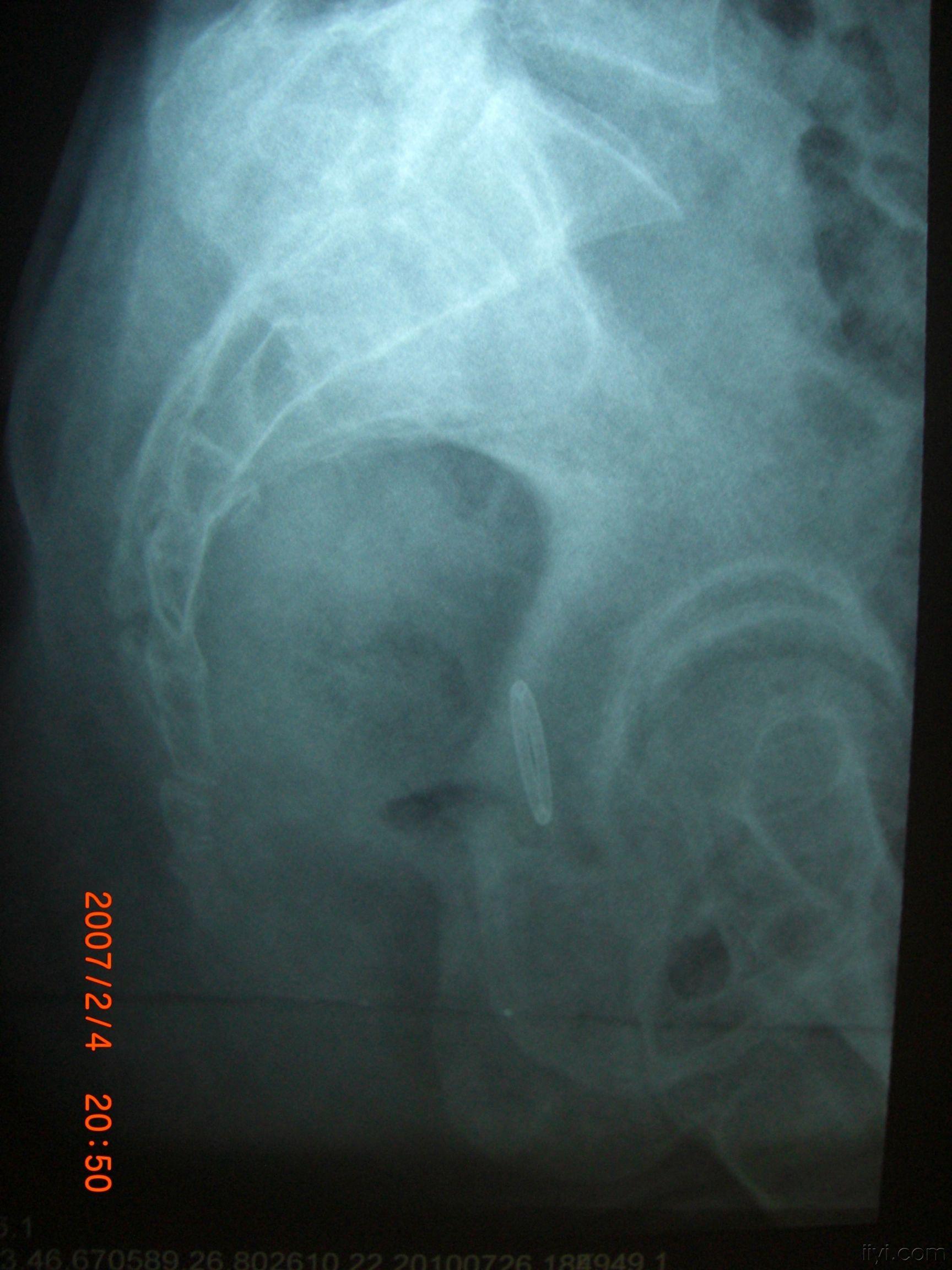 人体尾巴骨骨折图片图片
