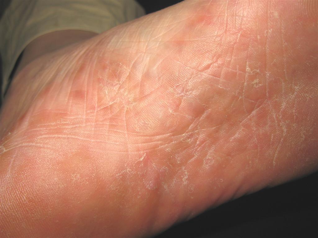 看图识病--------梅毒(一期,二期)