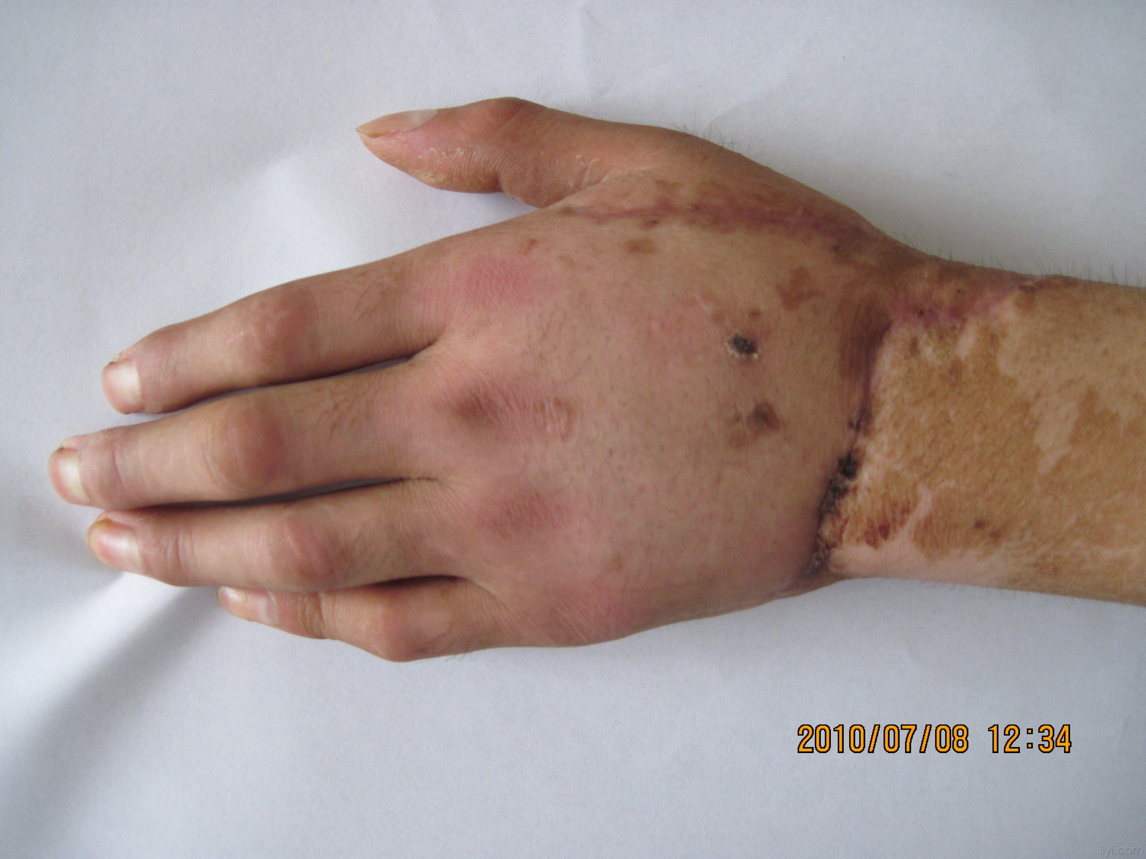 腕部完全离断再植成活一例报告.