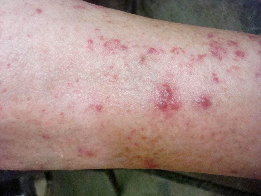 小腿带状疱疹症状图片图片