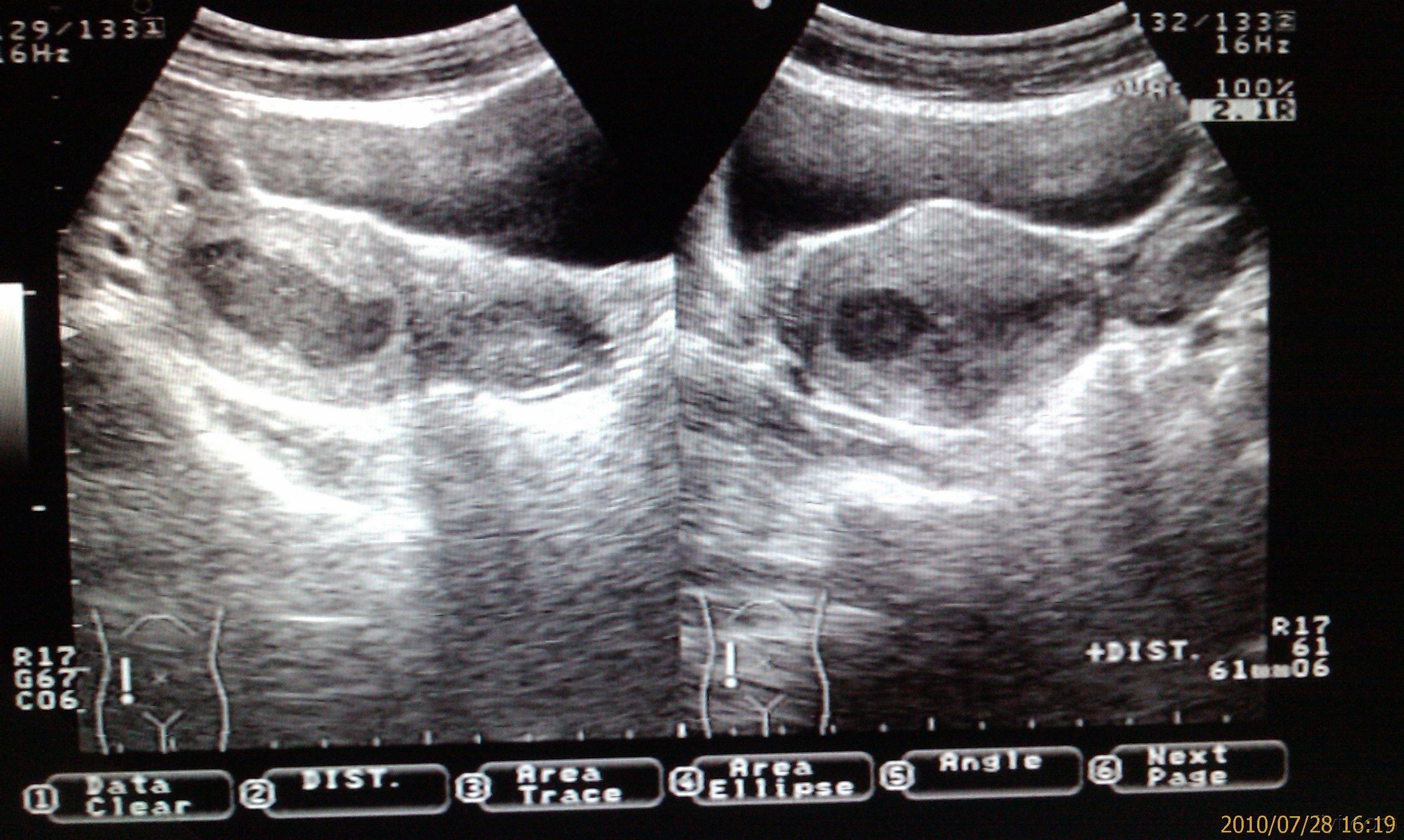 超声检查见,子宫左上方妊娠囊回声,宫腔内积血