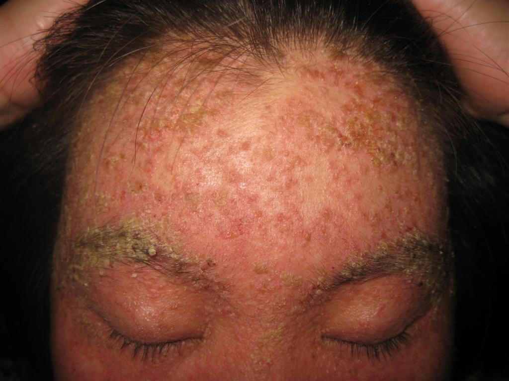 脂溢性皮肤炎早期图片