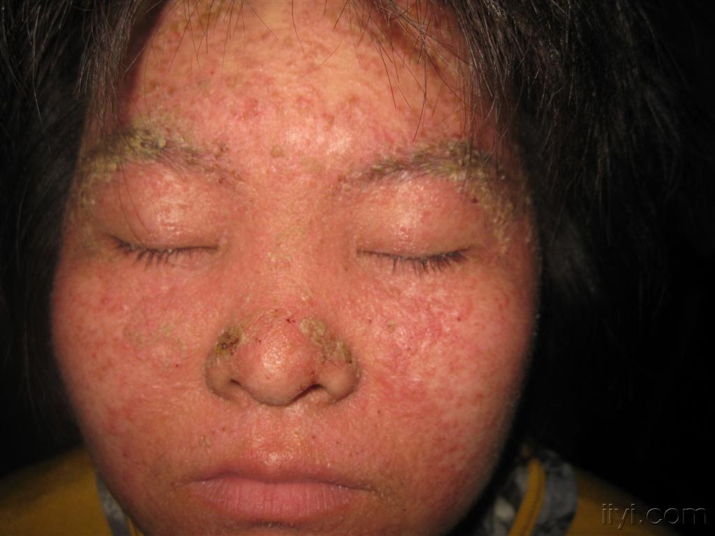 脂溢性皮肤炎早期图片