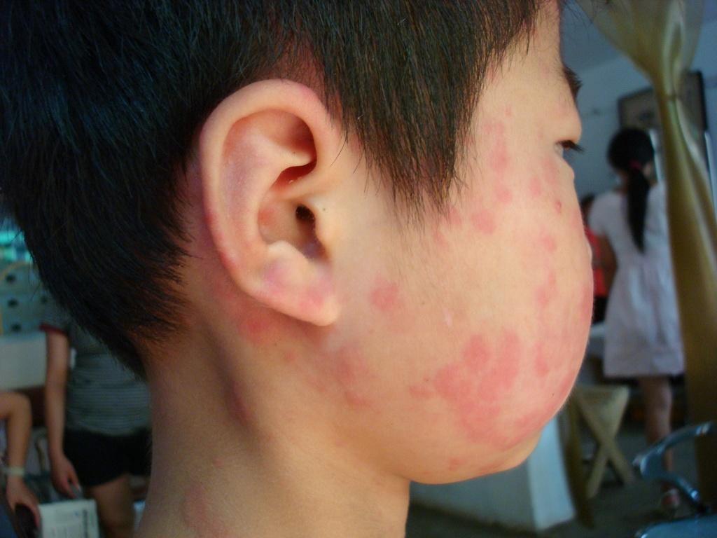 过敏性荨麻疹脸上图片
