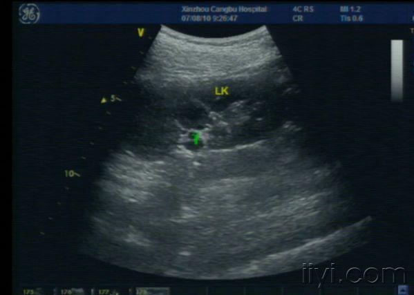 请分析这个右肾内的低回声是肥大的肾柱还是占位呢?
