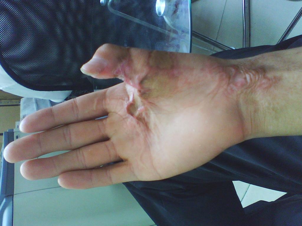 右手大拇指于15年前烧伤后皮肉挛缩畸形,现在拇指动不了