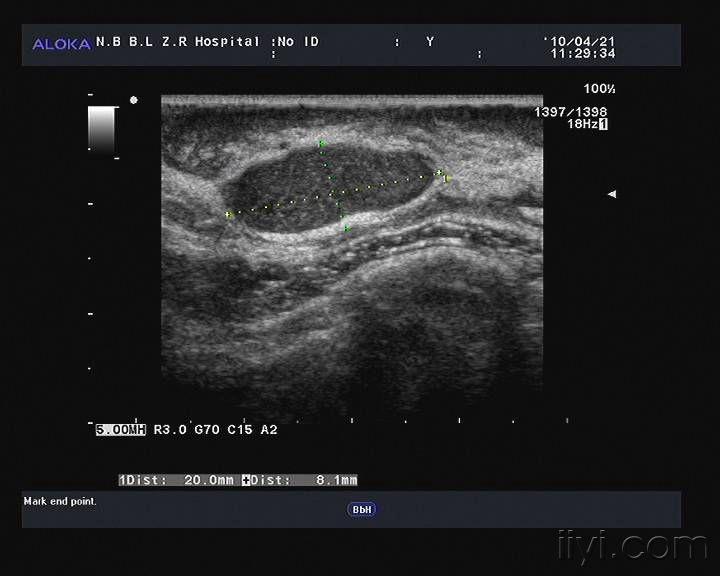 纤维瘤超声图片