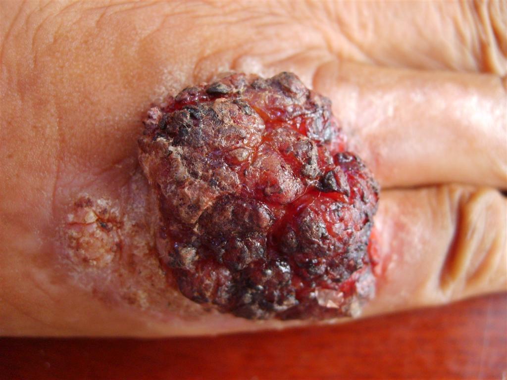 鳞状细胞癌早期症状图片
