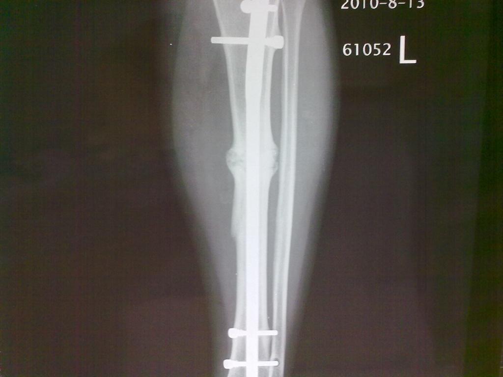 左脛骨骨折髓內釘術後不癒合7年