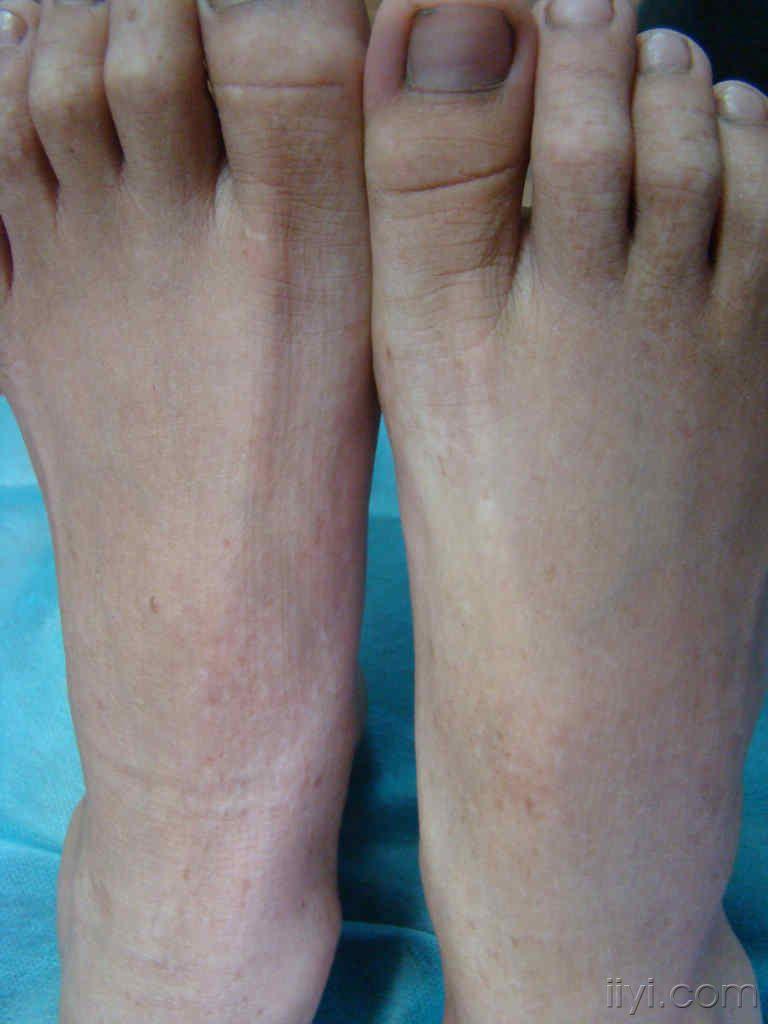 双手,足背色素沉着,减退斑-----遗传性对称性色素异常症