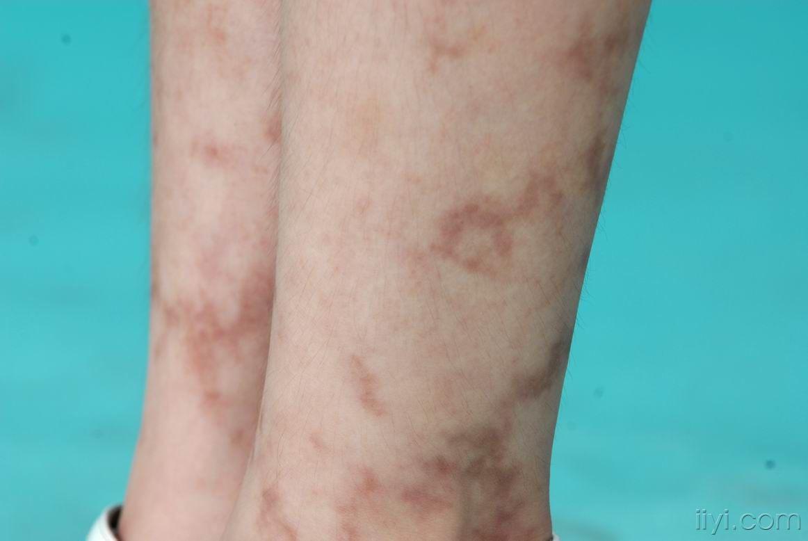 双下肢不规则形状色素斑18个月 - 皮肤及性传播疾病讨论版 - 爱爱医