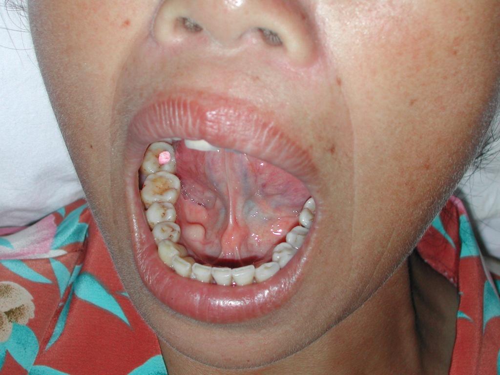 舌隆突增生图片图片