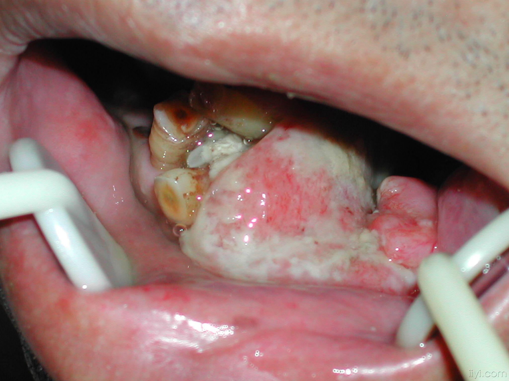 牙龈癌手术前后(图)