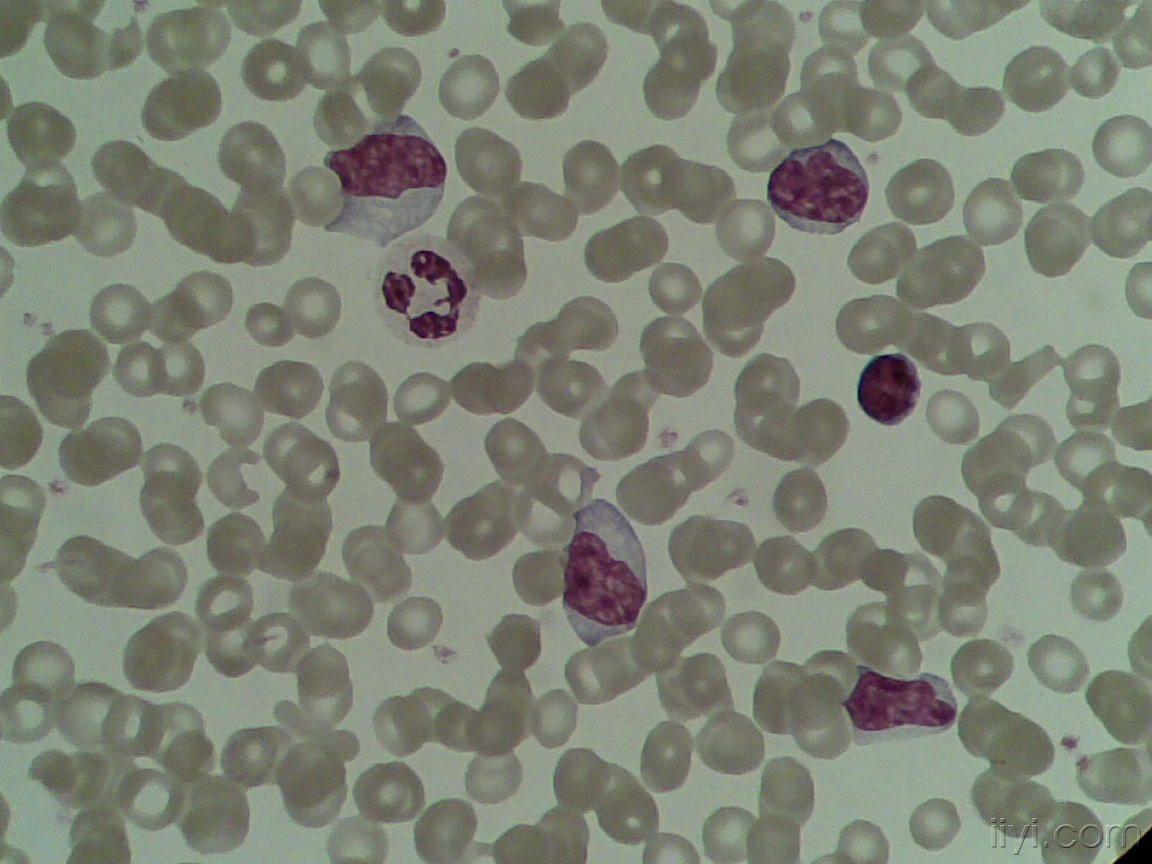 血片中的异型淋巴细胞 (一)
