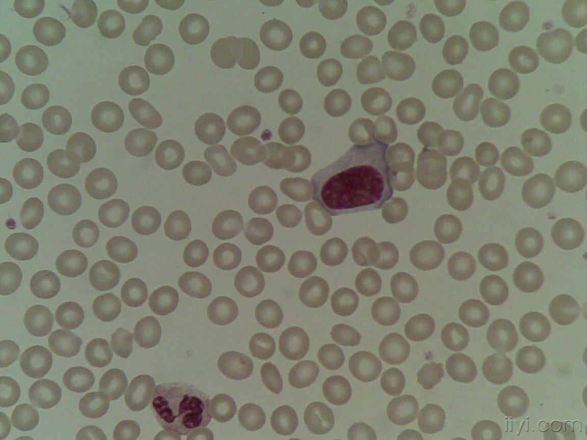 血片中的异型淋巴细胞 (一)