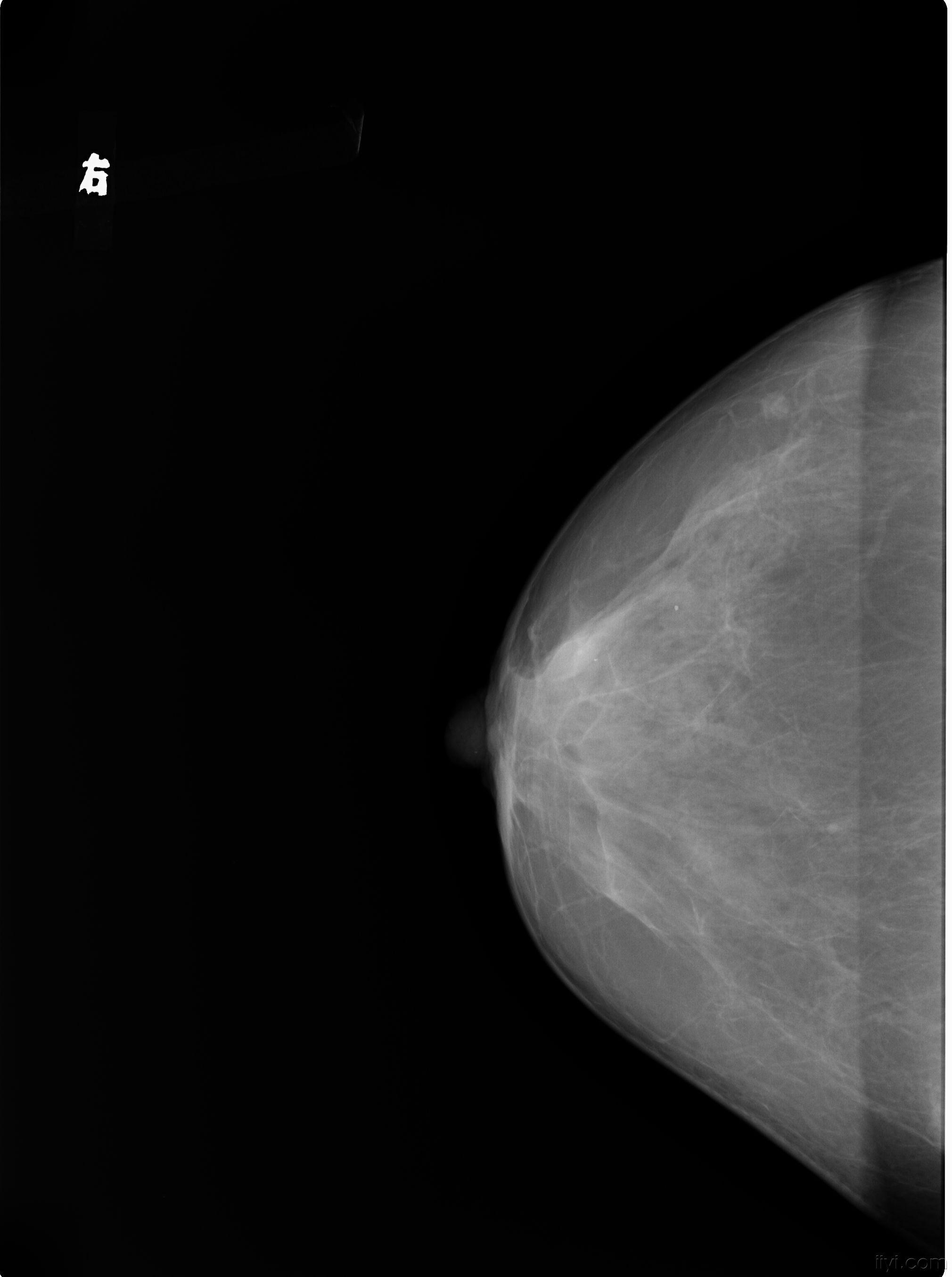 乳腺钼靶病例,有病理.