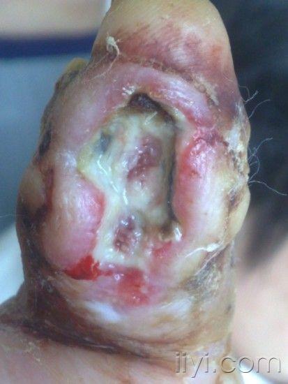 手指伤口化脓图片图片