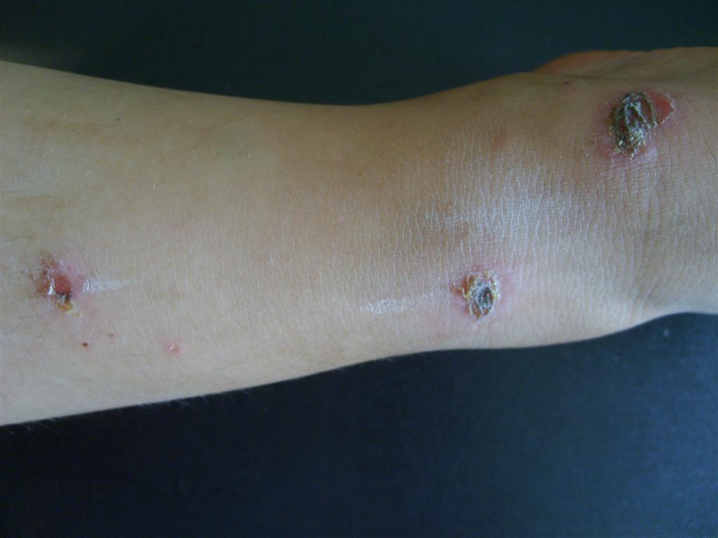 脓疱疮 - 皮肤及性传播疾病讨论版 - 爱爱医医学论坛 - 爱爱医医学网