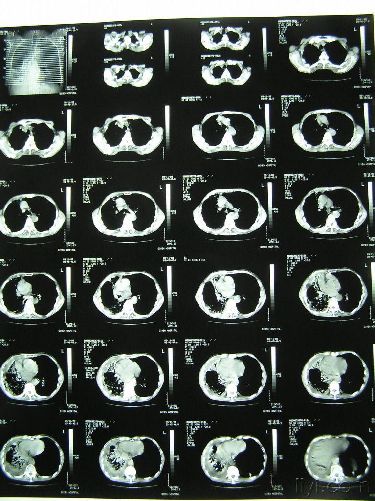 肺部阴影诊断图片