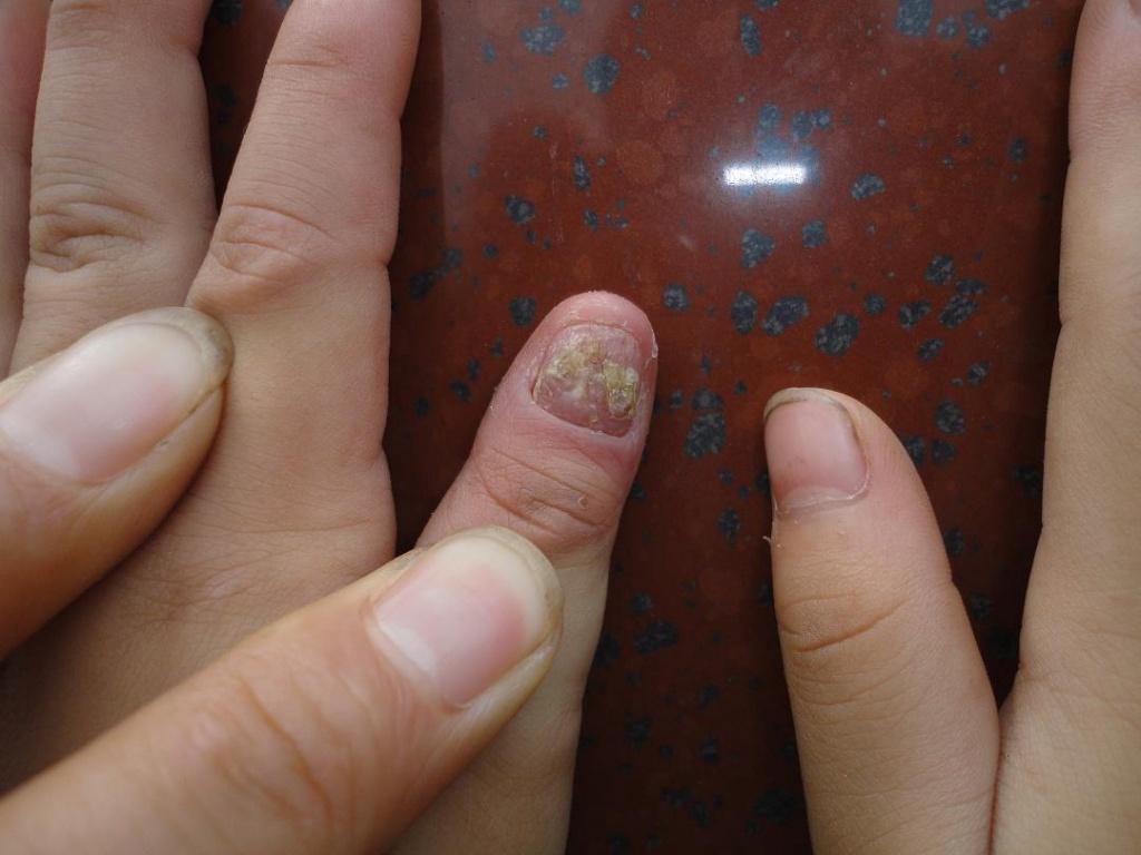 小孩的指甲病反复发作,该如何治疗?