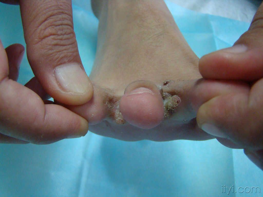 脚趾纤维瘤图片图片