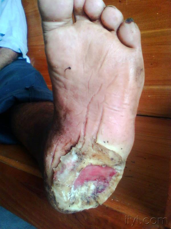 请大家分析讨论双脚底分别是什么样的溃疡又该如何处理.