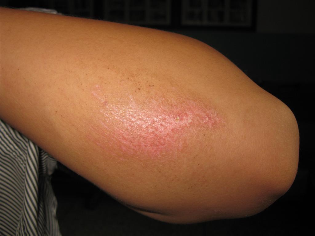 看图识病-------白癜风同形反应