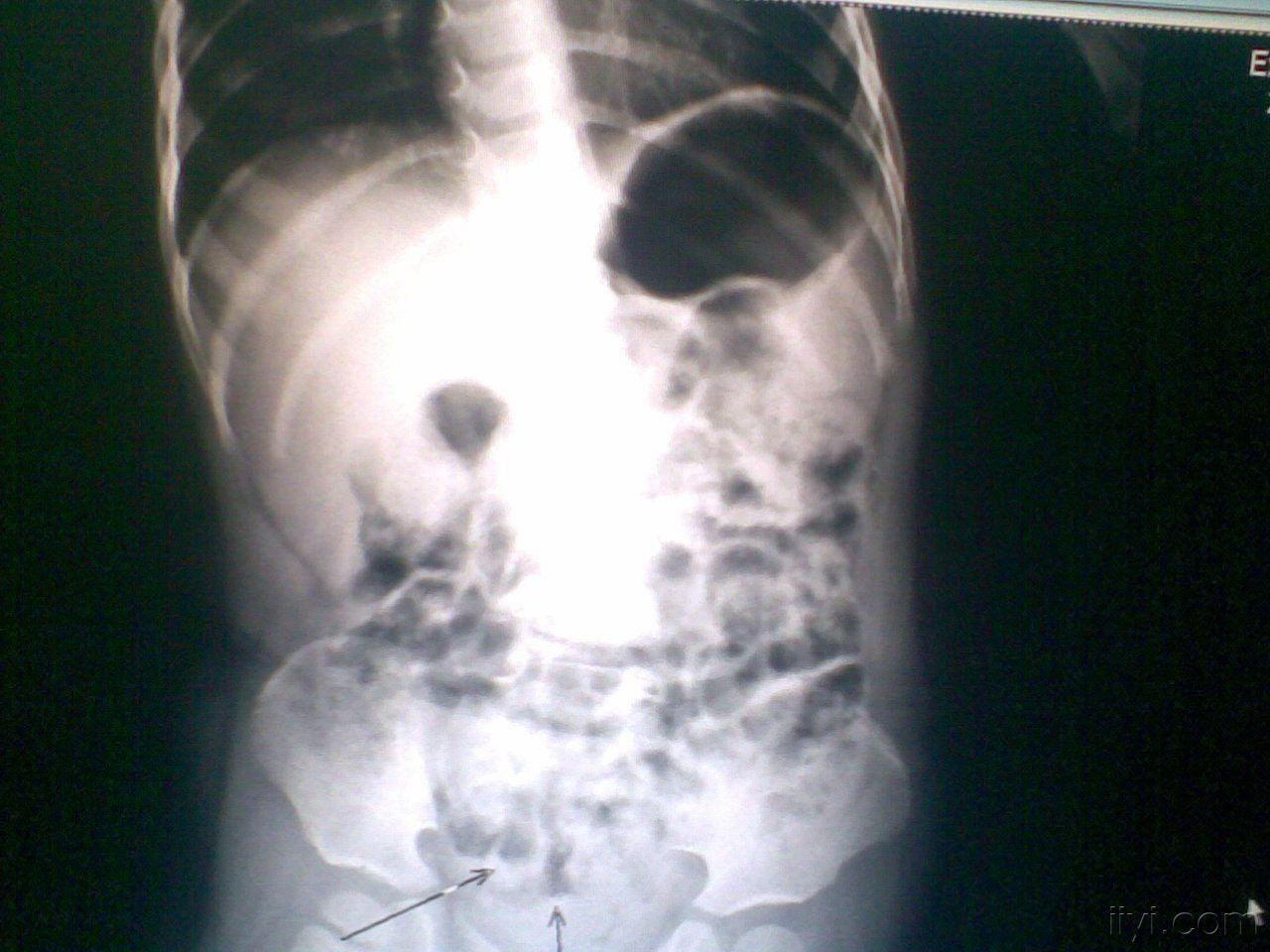 腹部立位片气液平面图片