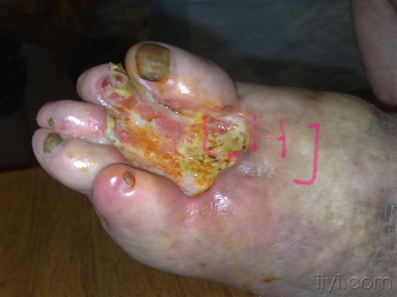 看图说话-足溃疡