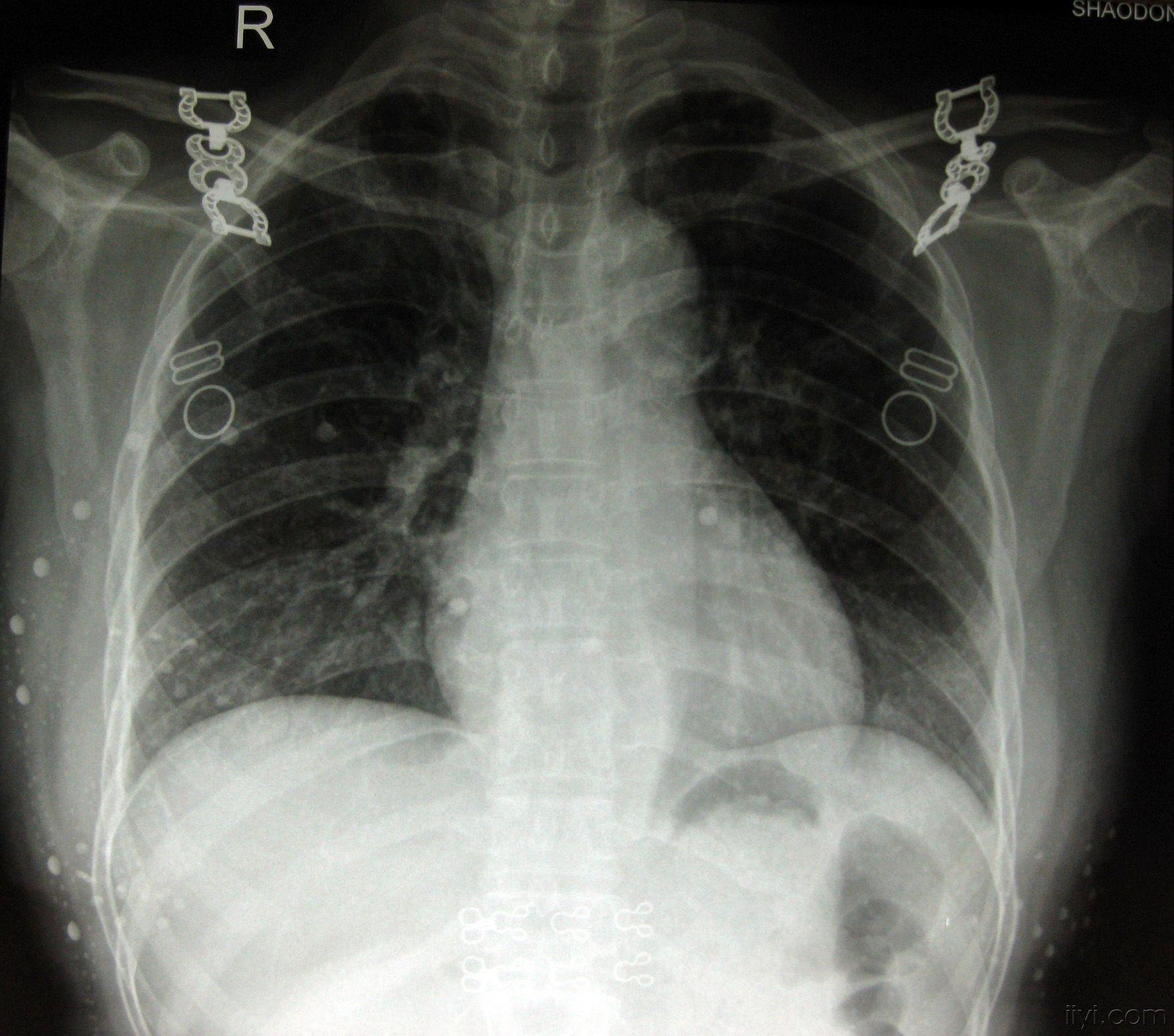 骨结核X光片图片