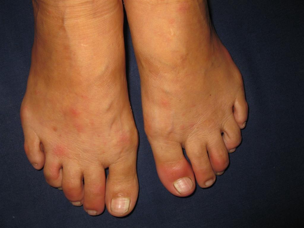 看图识病---------药疹