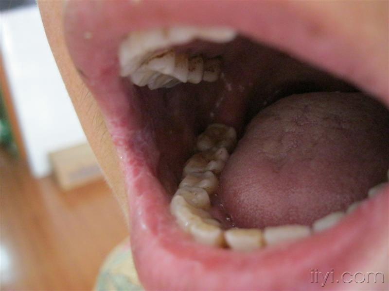 念珠菌口腔炎症状图片图片