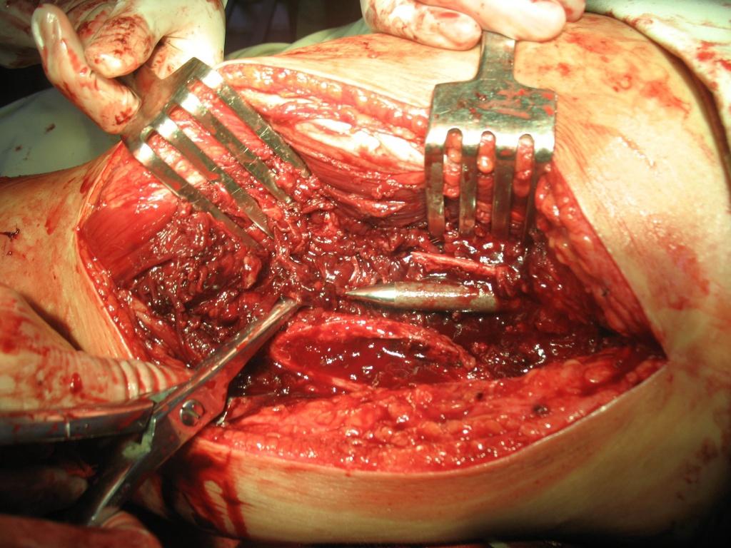 蹼状阴囊手术术后图图片