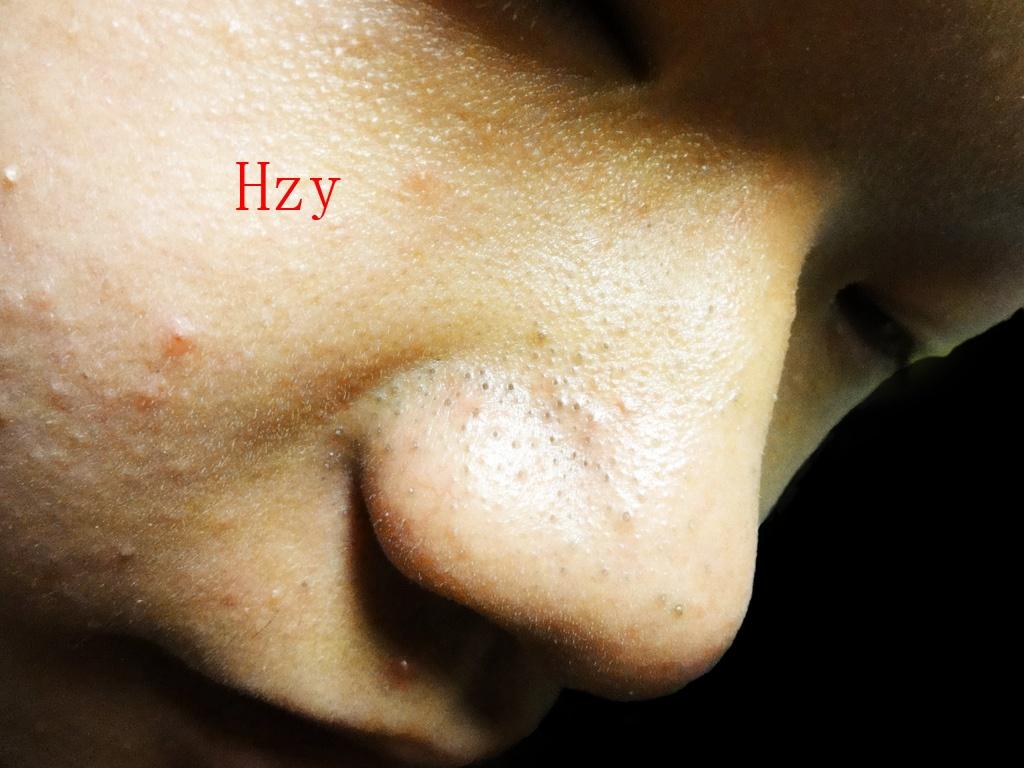 他鼻子上长了什么?公布答案:黑头粉刺