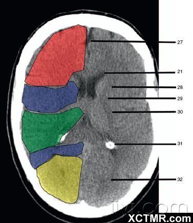 绿色部分为颞叶(temporal lobe,浅红色部分为额叶(frontal lobe)