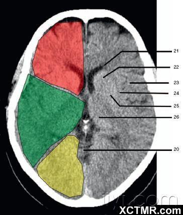 (medulla oblongata) 3,小脑 (cerebellum)  绿色部分为颞叶(temporal
