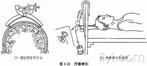 颅骨骨牵引进针点位置图片