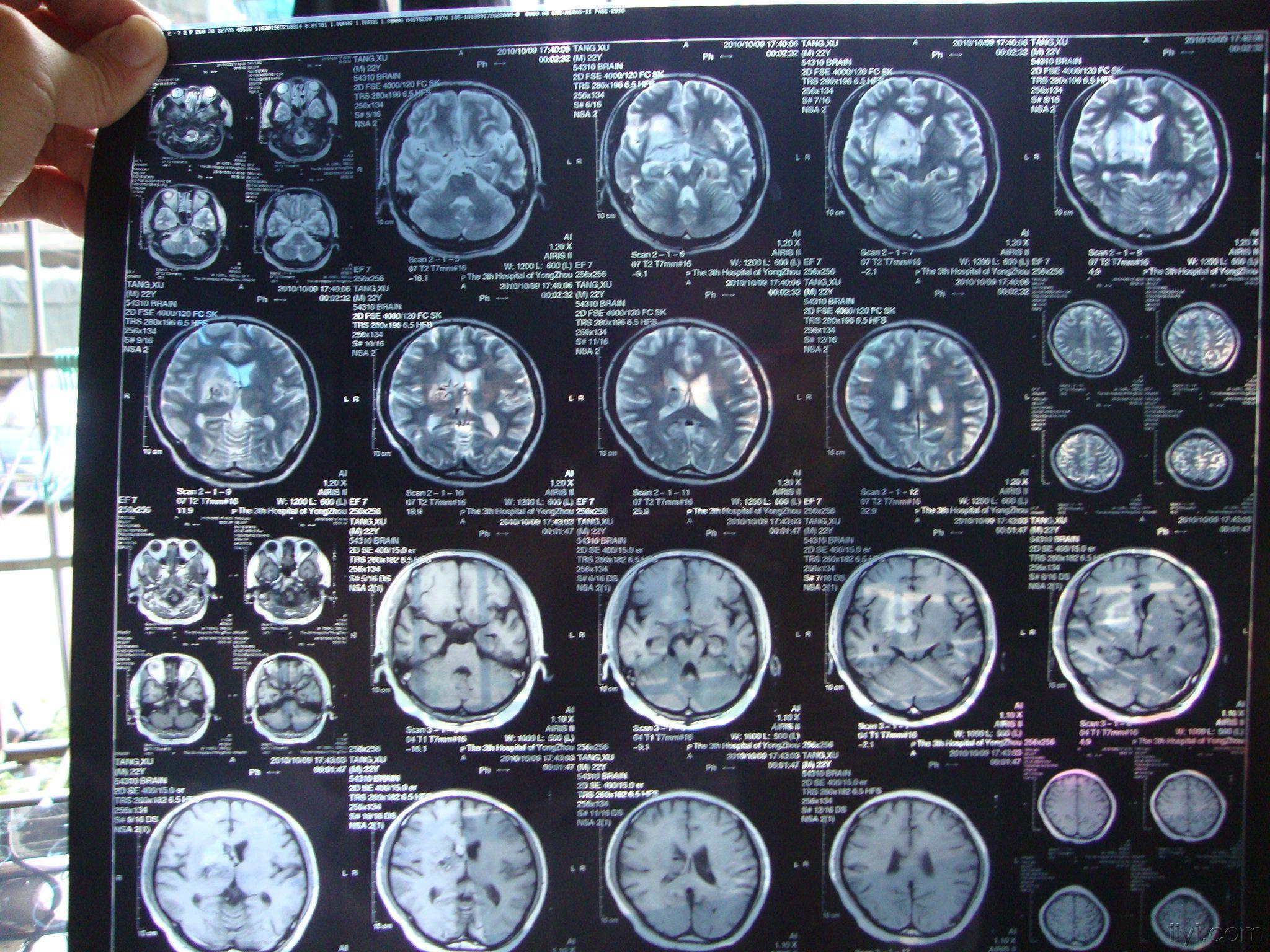 遂入院,核磁共振示顱內出血,現已3周,醫生診斷為先天性血管畸形,由於