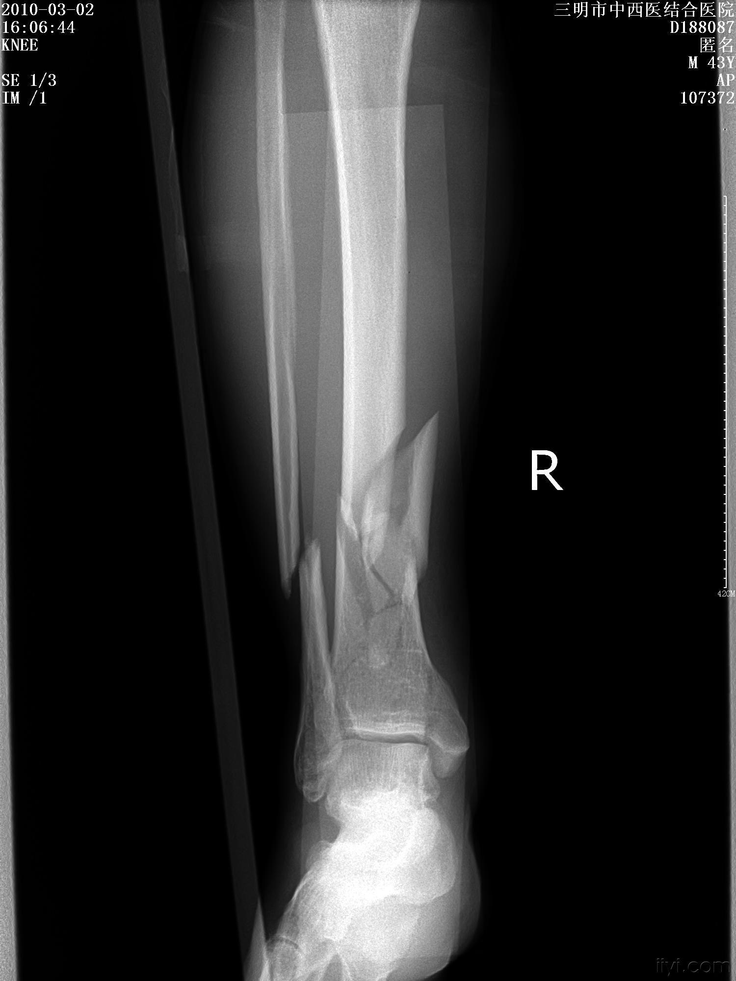 腿部骨折x光片图片图片