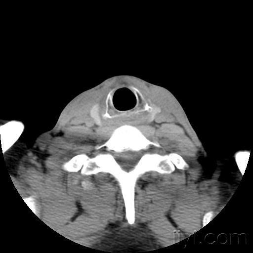 甲状软骨ct图片
