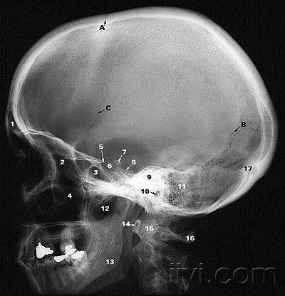 頭顱側位-x線片(dr) - 解剖圖片