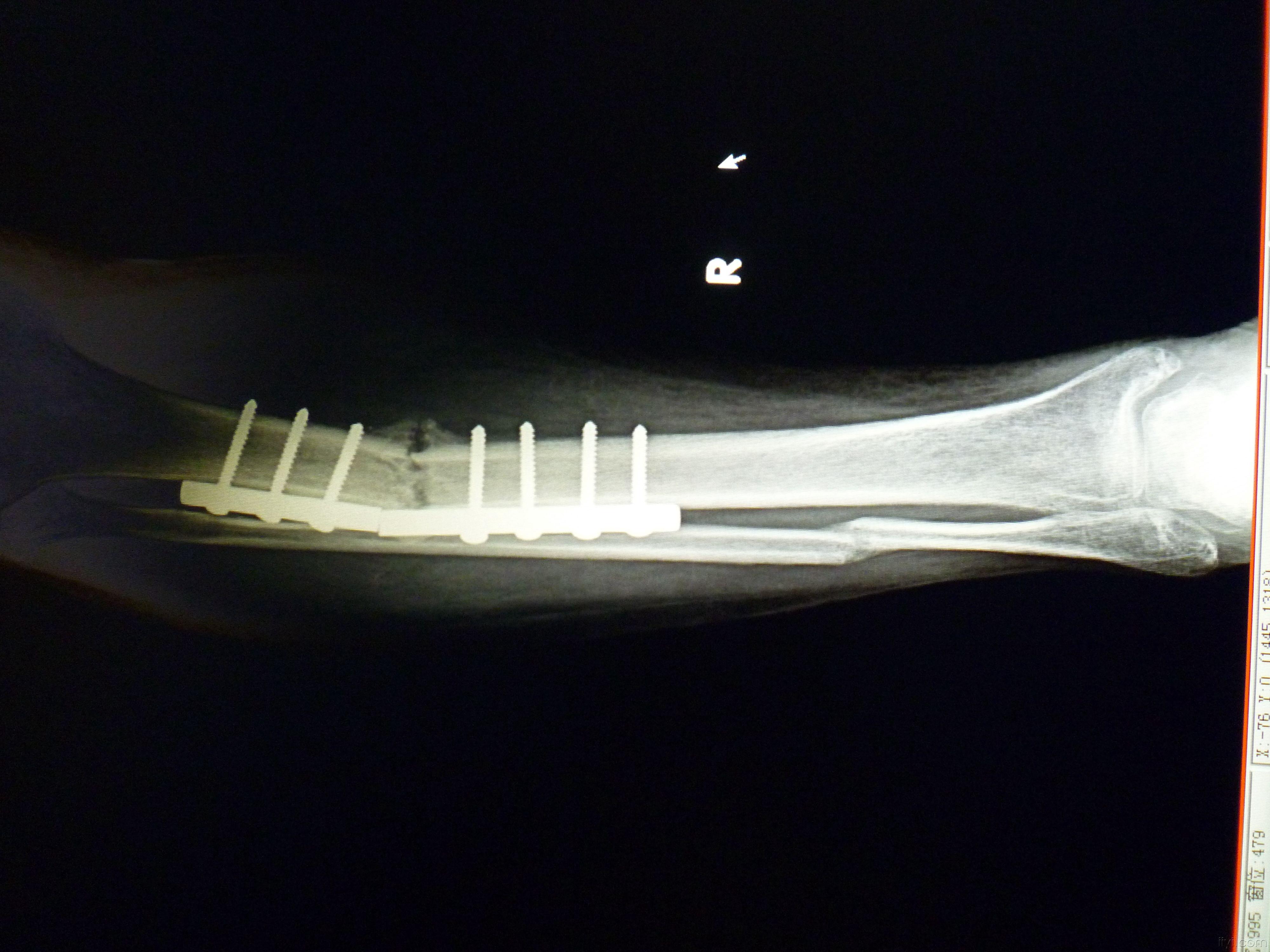 胫腓骨骨痂生长过程图图片