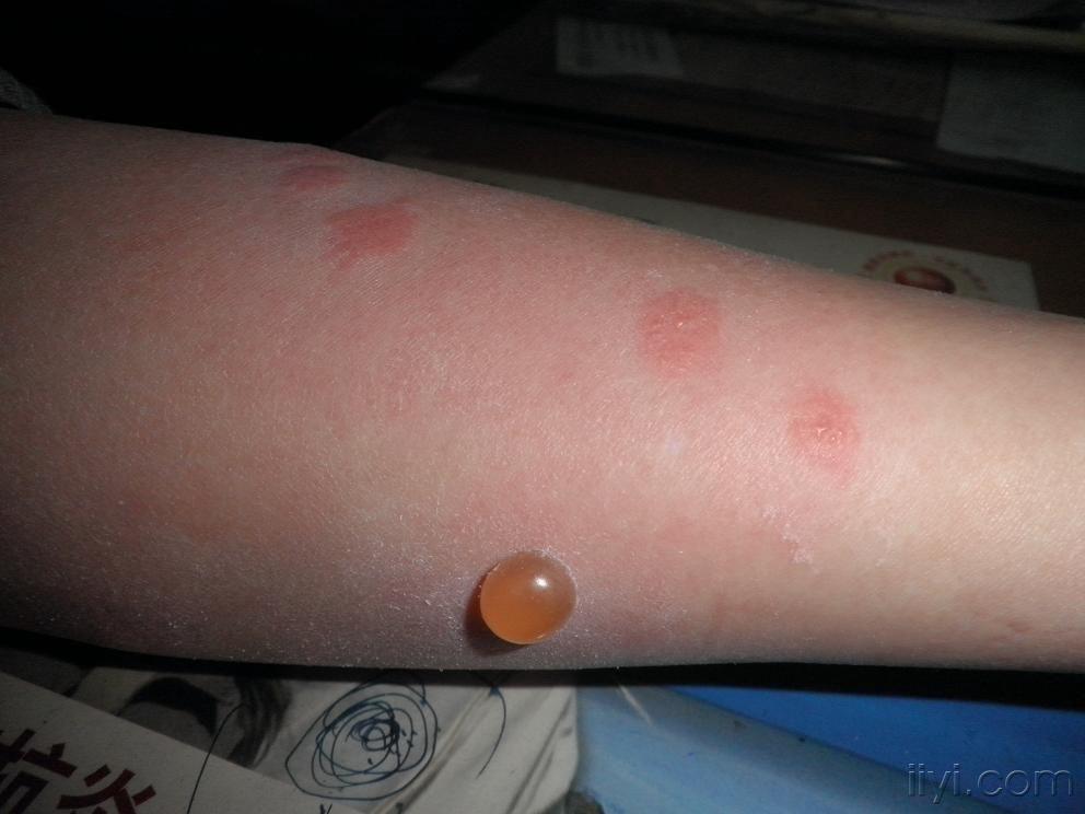 虫咬性荨麻疹怎么治疗图片