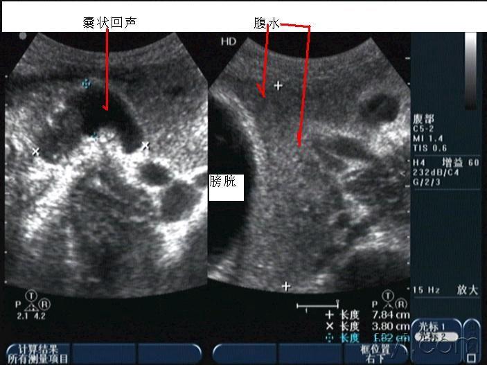 腹腔积液超声图片图片