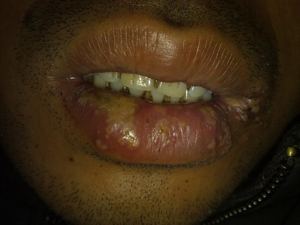 漂唇厌氧菌感染图片图片