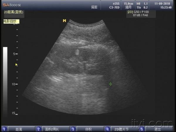 错构瘤超声图片