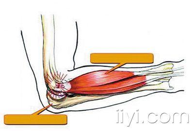 一針治好網球肘
