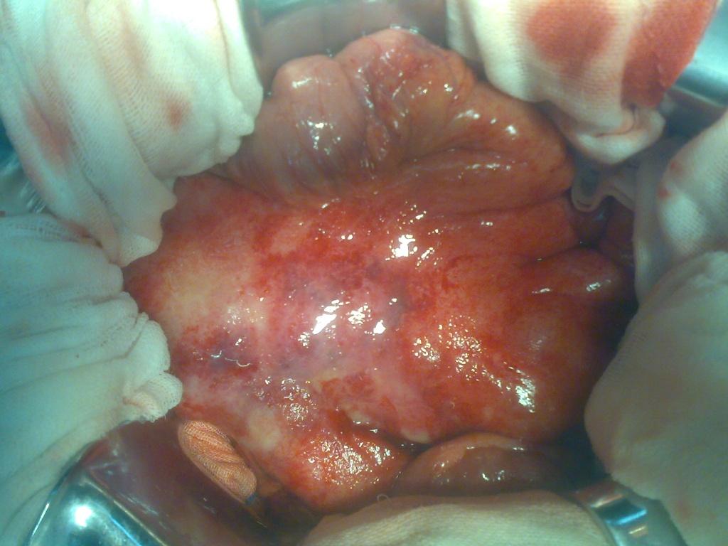 回肠末端淋巴瘤图片