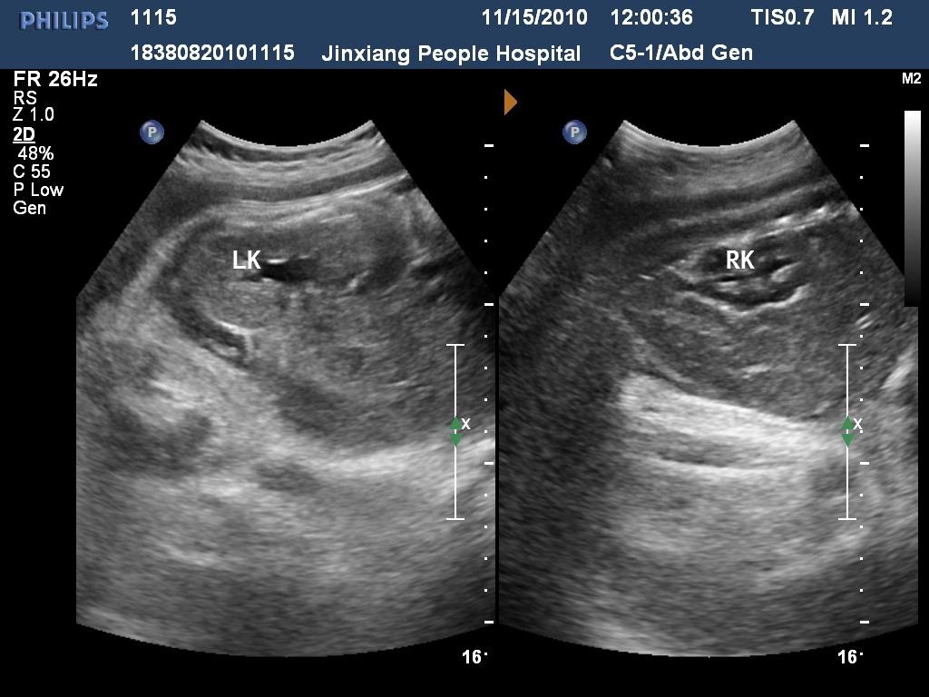 21:41:44胎兒左腎明顯增大,而右腎正常